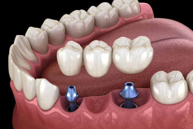 Zubný mostík: Obnova funkcie a úsmevu | Dental Centrum NIVY