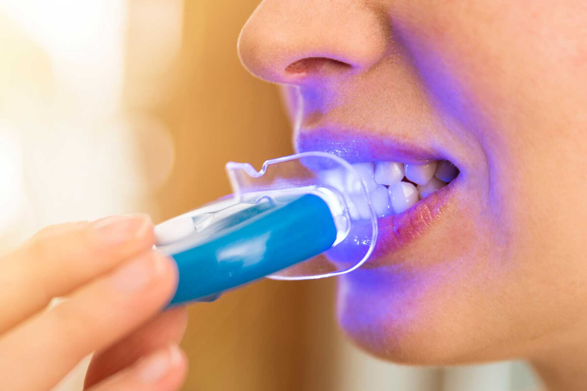 LED svetlá na domáce bielenie zubov, áno alebo nie? | Dental Centrum NIVY