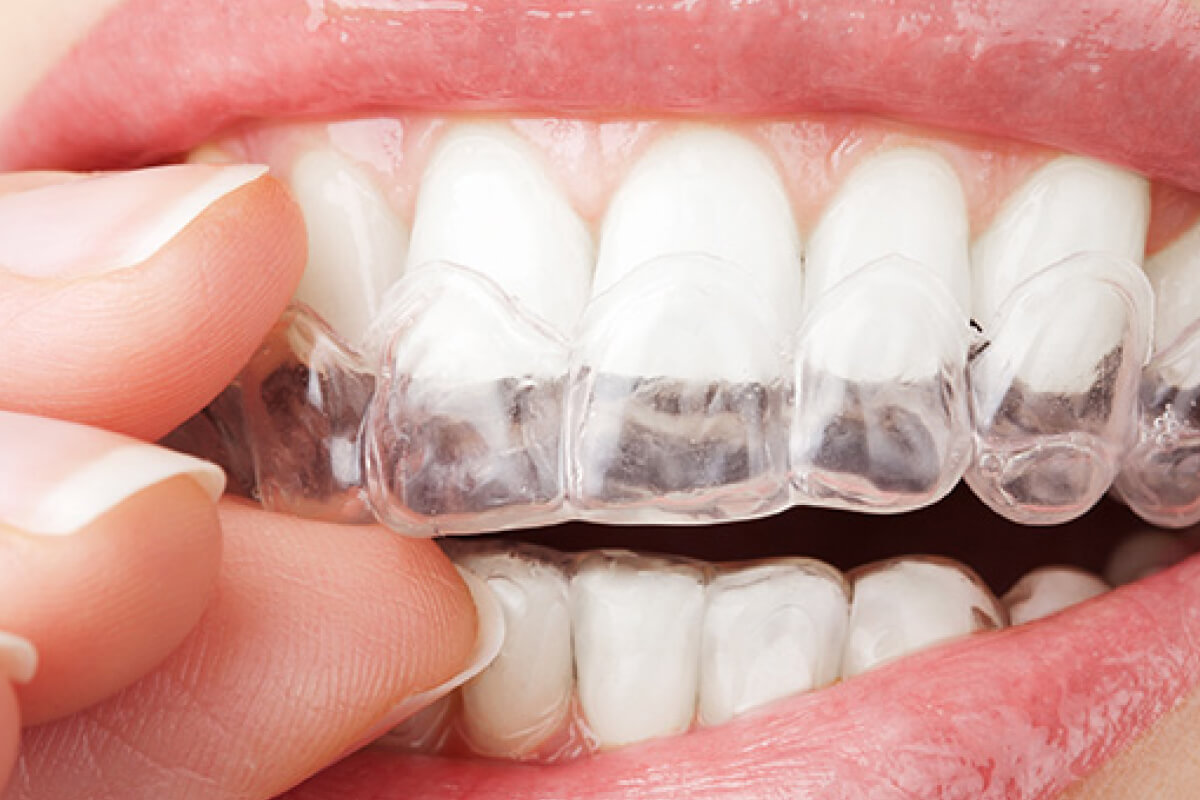 Tipy na bezpečné domáce bielenie zubov od dentálnej hygieničky | Dental Centrum NIVY