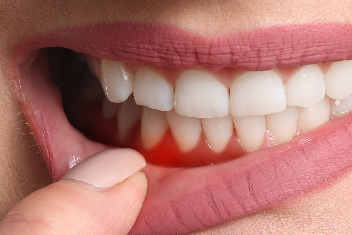 Parodontitída alebo parodontóza? Aké sú jej príznaky a liečba? | Dental Centrum NIVY