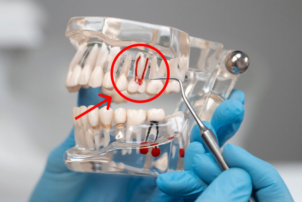 Čo je to endodoncia? Vysvetlenie krok po kroku | Dental Centrum NIVY