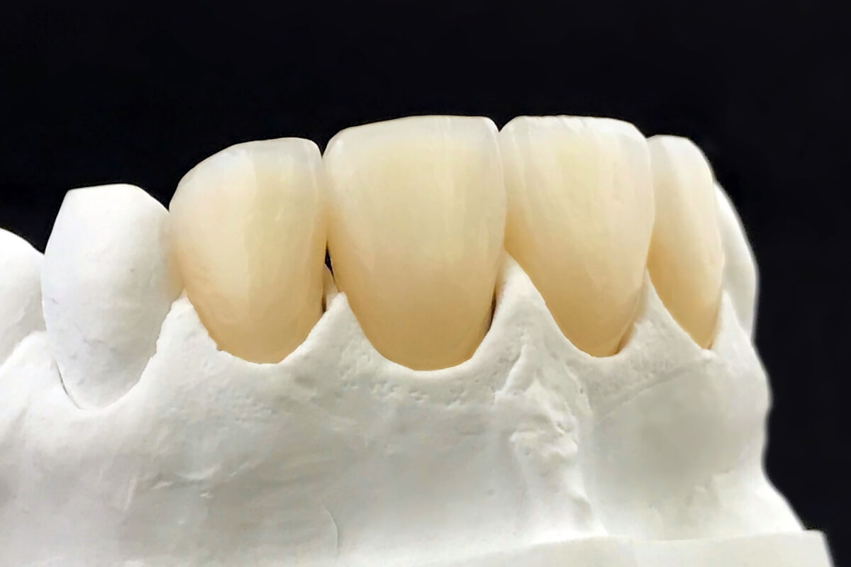 Čo sú to fazety na zuby? | Dental Centrum NIVY