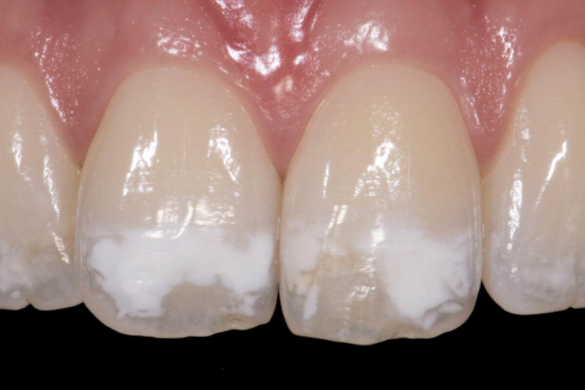 Pre koho sú zubné fazety vhodné? | Dental Centrum NIVY