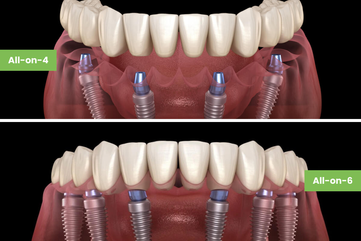 Celková rekonštrukcia chrupu | Dental Centrum NIVY