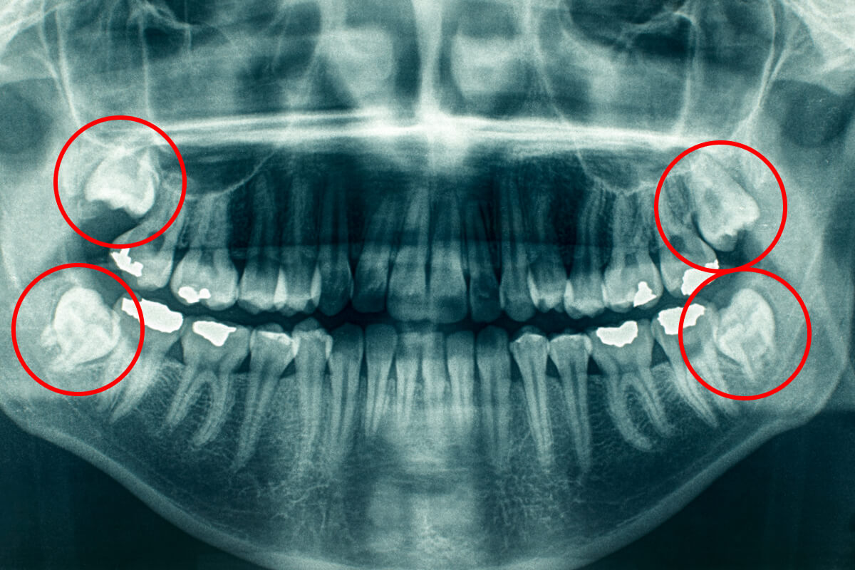 Chirurgická extrakcia osmičiek | Dental Centrum NIVY