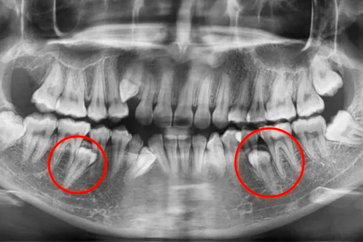 Chirurgická extrakcia zubu| Dental Centrum NIVY