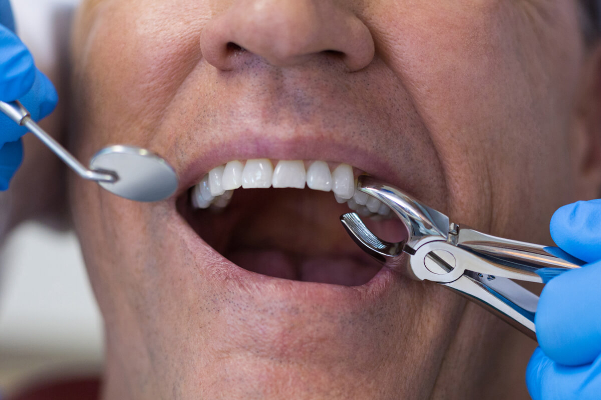 Vytrhnutie zuba bez bolesti | Dental Centrum NIVY