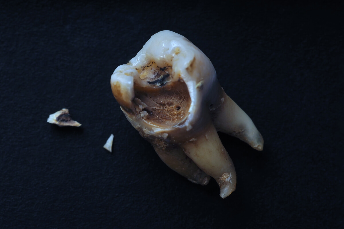 Extrakcia zuba s rozsiahlym kazom | Dental Centrum NIVY