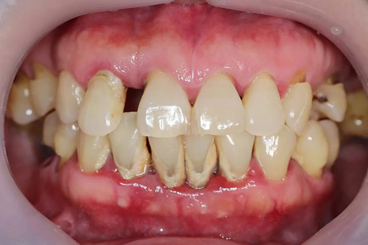 Parodontitída | Dental Centrum NIVY