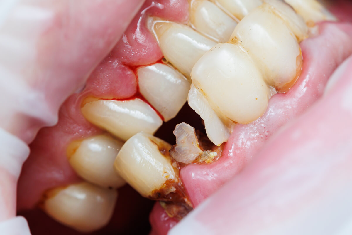 Zlomenina koreňa zuba | Dental Centrum NIVY