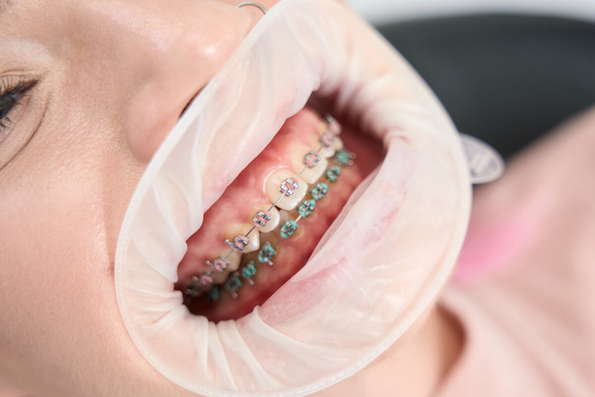 Ortodontická liečba | Dental Centrum NIVY