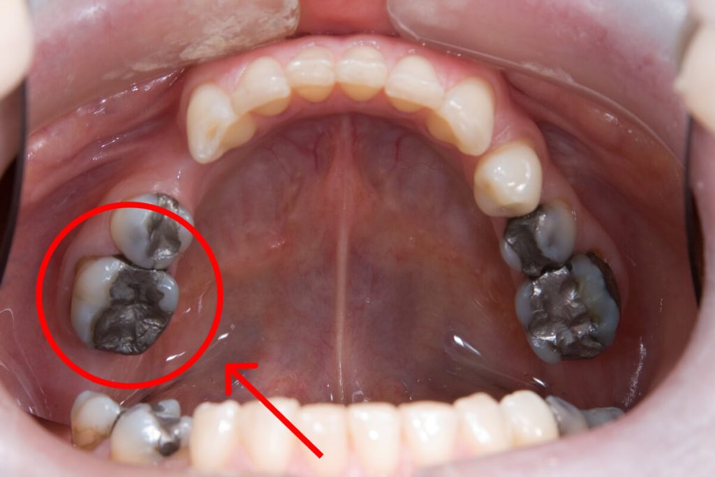 Amalgámové plomby skončili | Dental Centrum NIVY