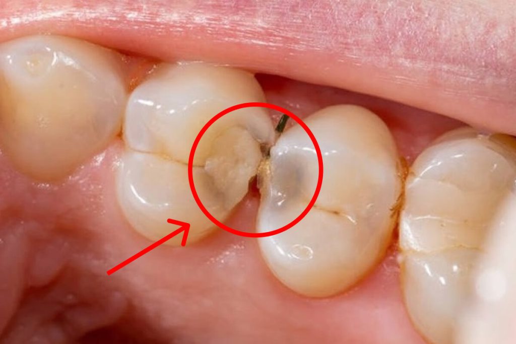 Tipy ako zastaviť začínajúci zubný kaz | Dental Centrum NIVY