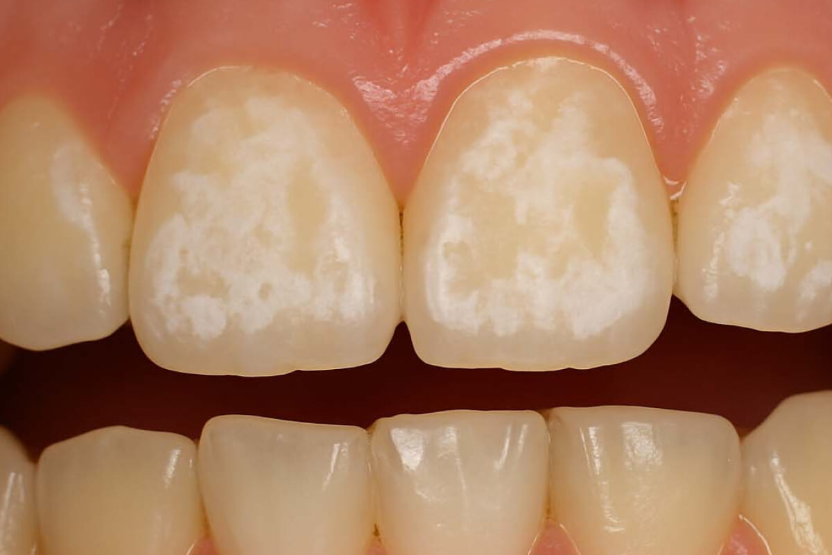 Demineralizácia zubov| Dental Centrum NIVY