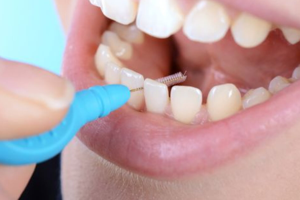 Tipy na čistenie medzizubných priestorov | Dental Centrum NIVY