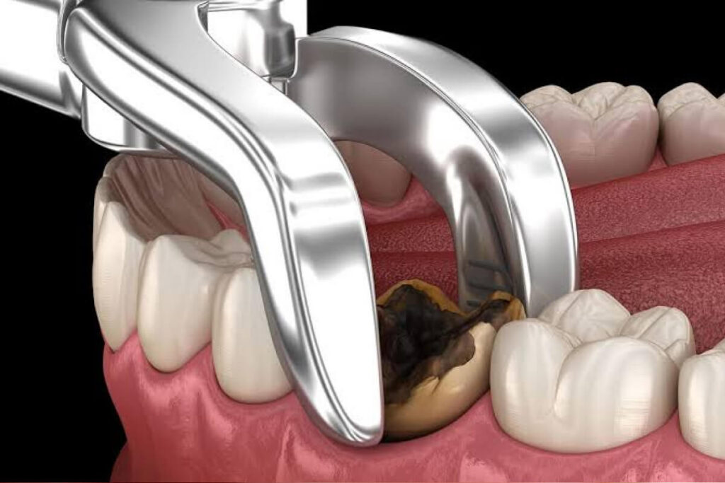 Extrakcia zuba a jej komplikácie | Dental Centrum NIVY
