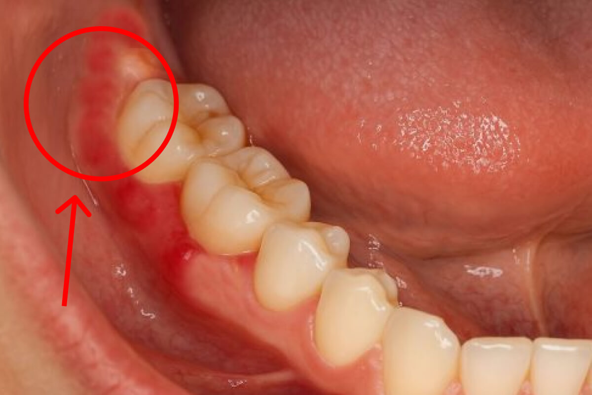 Zápal po extrakcii zuba a bakteriálna infekcia | Dental Centrum NIVY