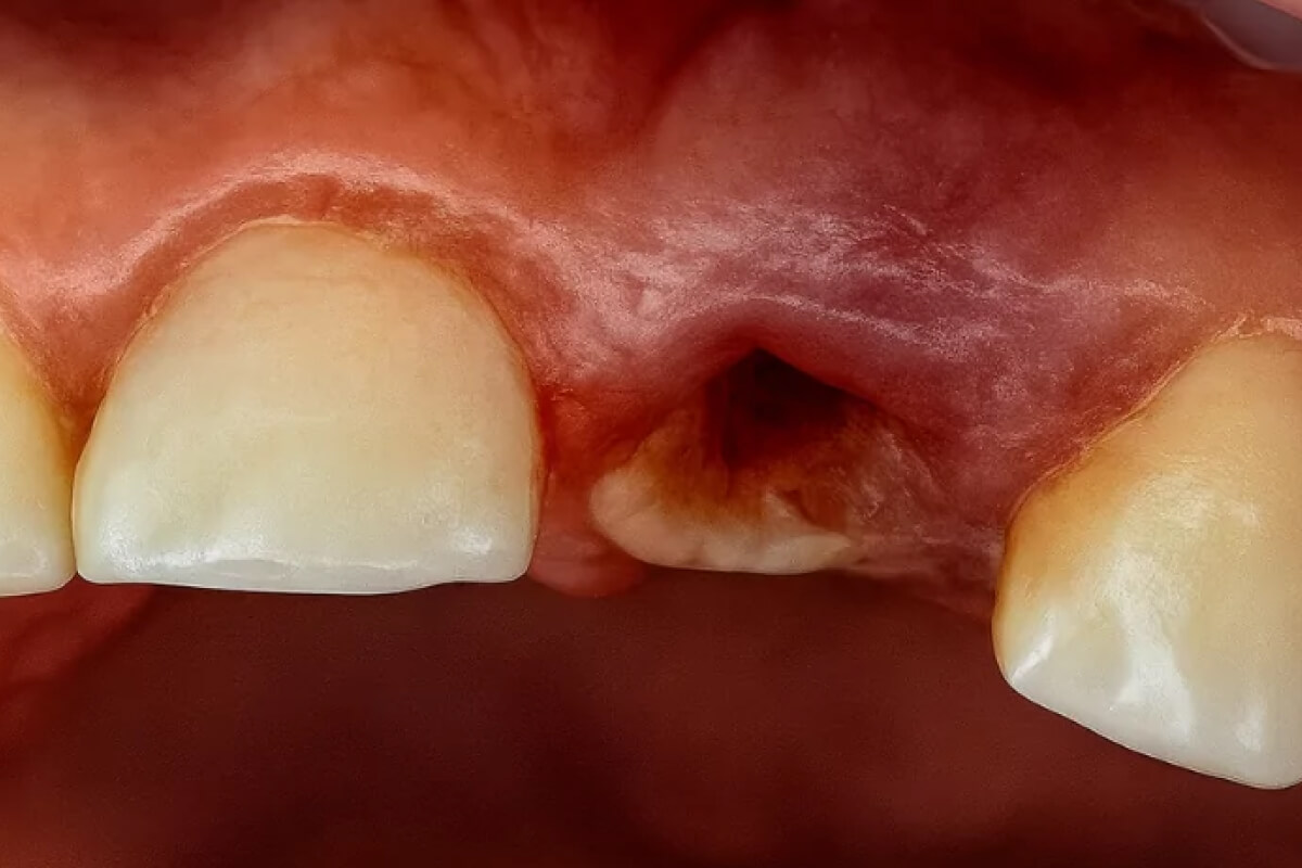 Neúplná extrakcia zuba a zalomený koreň | Dental Centrum NIVY
